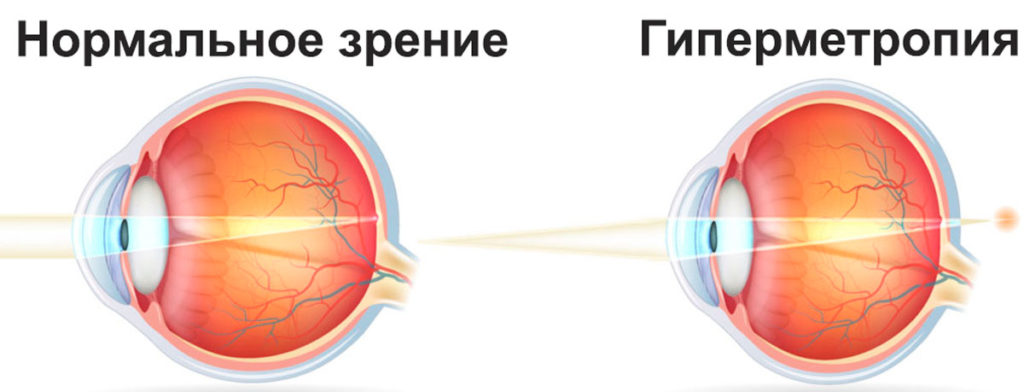 Дальнозоркость - это